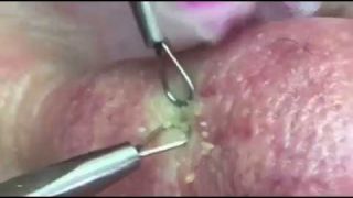 Pimple popper style- Congestion of pores
